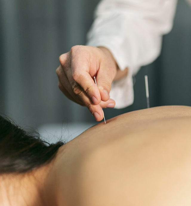 Acupuncture