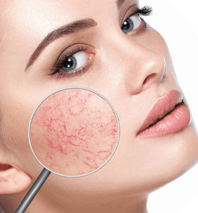 Capillaries on the face